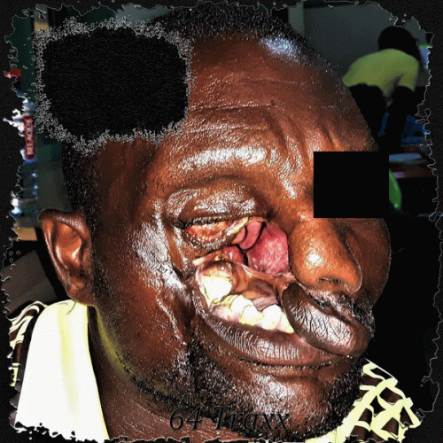 Lymphangiomas : 64 Traxx